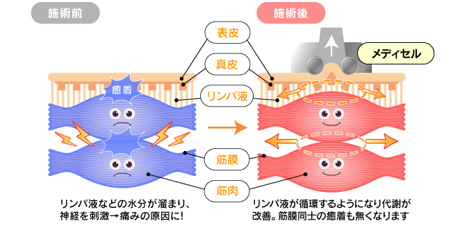 メディセルイメージ